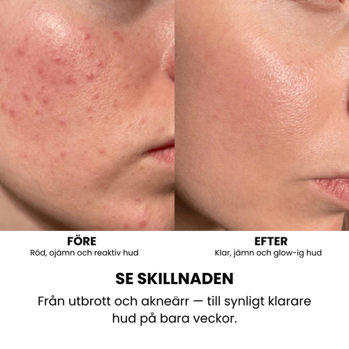 Skinresolution – Klarare, yngre hud på 14 dagar